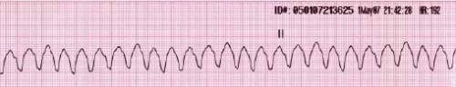 What is most likely true of a person who has this heart rhythm?  the person is taking drugs to