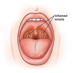 The medical term meaning an inflammation of the pharynx is