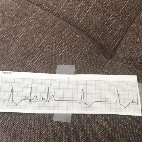 What is the name of the abnormality in this ecg