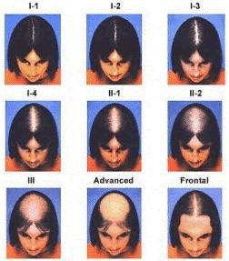Compare men vs. women on the topic of alopecia areata