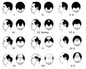 Compare men vs. women on the topic of alopecia areata