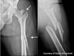 Afracture is a  in the bone. it can occur from either a quick, one-time injury to the bone, or from