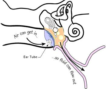 What does it mean when someone gets “tubes put in their ears”?  where are they put?  why?