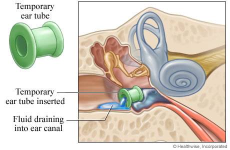 What does it mean when someone gets “tubes put in their ears”?  where are they put?  why?
