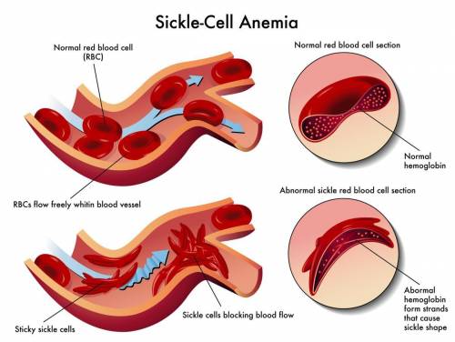 What organelle does sickle cell anemia affect?