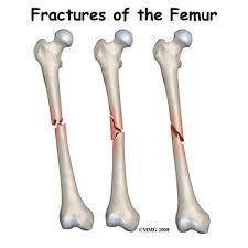 How does the shape of the treated femur compared with that of the untreated femur?
