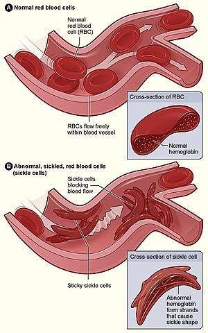 This image shows the RBCs of a person with sickle cell anemia, an inherited condition. What effects