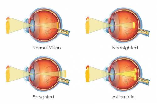 Which of the following accurately compares nearsightedness and farsightedness? (1.0 points) A)Nearsi