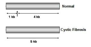 Restriction maps of two alleles of the cystic fibrosis gene are shown below. the restriction enzyme
