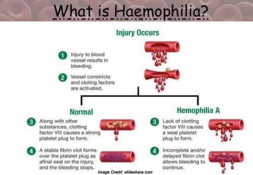 Hemophilia is a genetic blood disorder that is caused by a defective protein in the platelets. what 