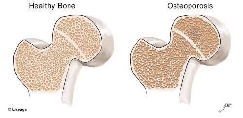 Osteoporosis is a disease that affects the bones and leads to an increase in bone fractures. Osteopo