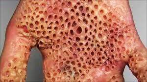This is a real thing true or false its called trypophobia disease