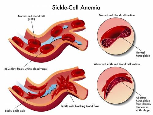 Whih type of blood cell does sickle cell anaemia affect?