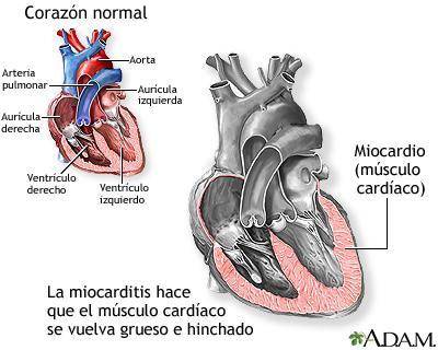 ¿Qué crees que sucedería si la función del miocardio se ve afectada por una miocarditis?