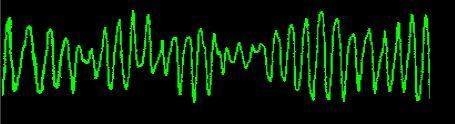 What is this heart rhythm? a. ventricular fibrillation b. torsade de p. c. asystolie d. atrial fibr