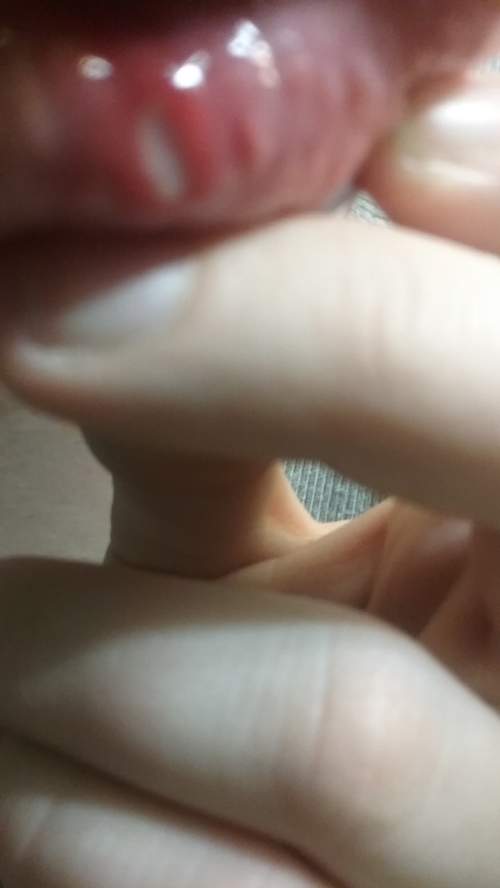 Sam found this on his inner lower lip. explain how to diagnose and treat