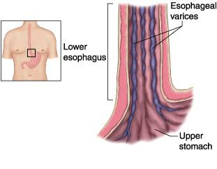 ​which term means enlarged and swollen veins at the lower end of the esophagus?  a. ​varicose veins 