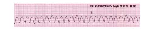 This picture shows what the heart rhythm looks like when there is an injury to the heart muscle due