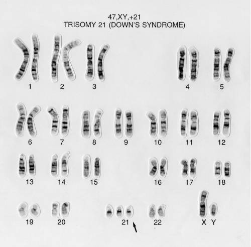 What is Down’s syndrome? What is it the result of? What would its karyotype look like?