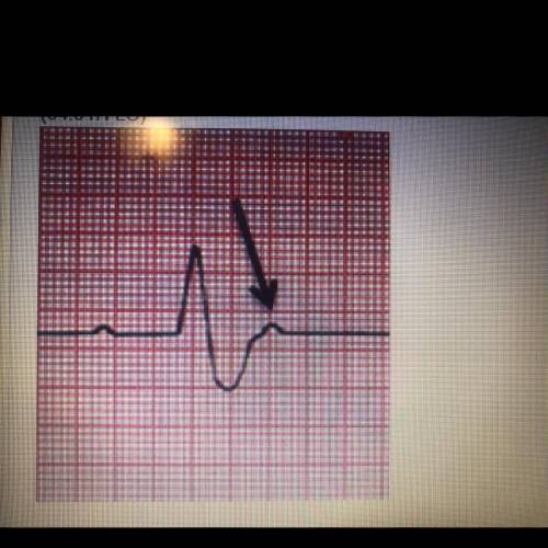 FOR 40 POINTS!!!

 
Which statement described the condition of the heart at the point indicated in