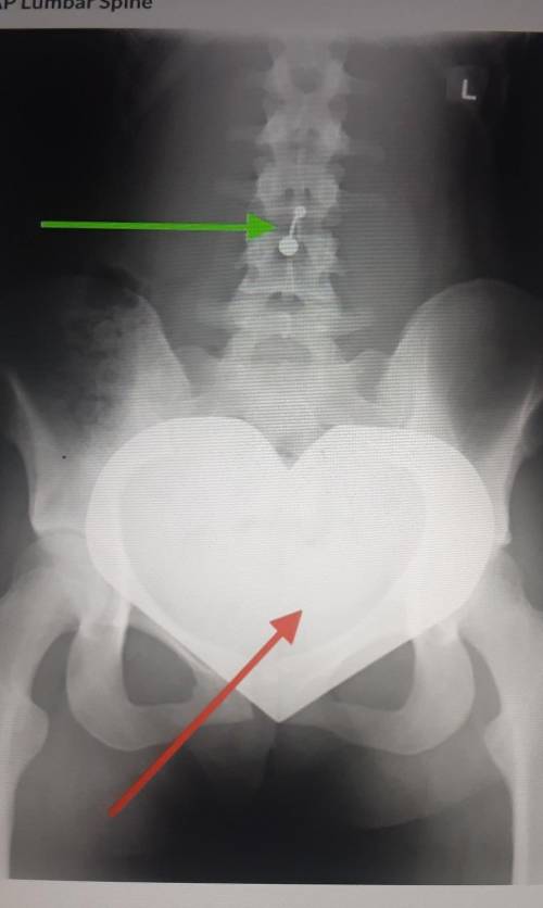 Metal shows up bright white in x-rays to to its density. the Green Arrow indicates a belly ring but