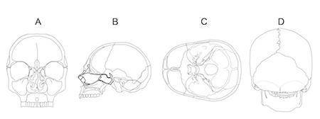 An anatomist needs to cut a skull open with a transverse cut. Which of the diagrams correctly shows