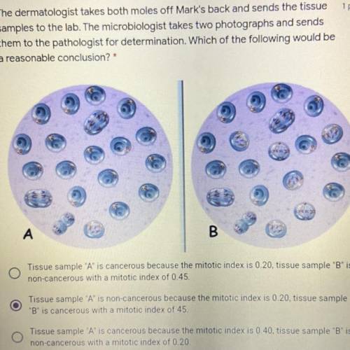 The dermatologist takes both moles off Mark's back and sends the tissue

samples to the lab. The m