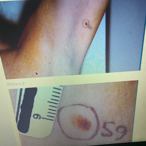 The patient reported that the mole was new and had grown much larger during the previous six months