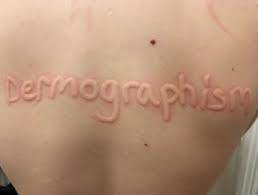 Does anyone else have this...

Dermatographia is a condition in which lightly scratching your ski