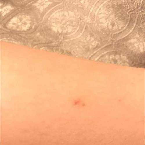 There’s a bite on my leg, can someone let me know what it is?