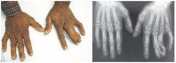 The photos shown below illustrate a case of synpolydactyly, a genetic abnormality characterized by