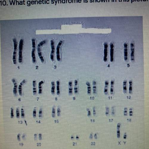 10. What genetic syndrome is shown in this picture? *