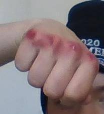 FREE POINTS WUTS 956+6670

So ig my angers bit bad bcuz this is how my hand is after punching some
