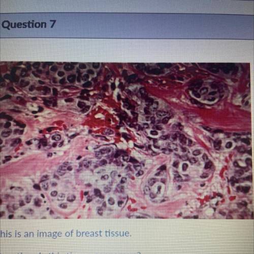 This is an image of breast tissue.

Question: Is this tissue cancerous?
Evidence: Select all evide