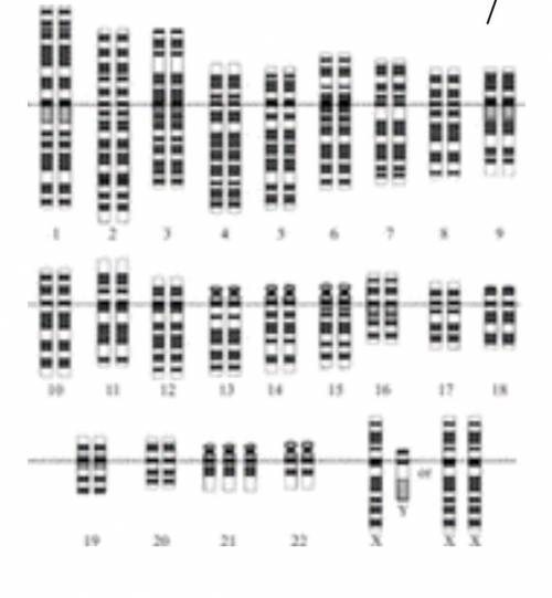 Record the disorder revealed in the karyotype below.
I need help