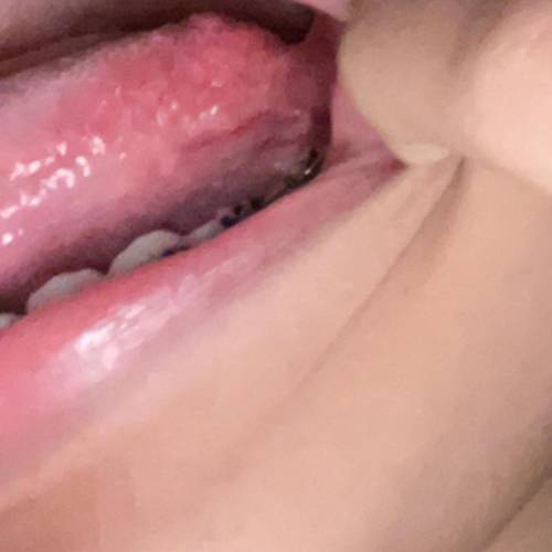 is this normal? cause i just checked my tongue today and i saw this? and i ate a lot of spicy food
