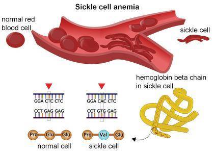 QUESTION:

Select the correct answer.
Sickle cell disease is a hereditary mutation that causes the