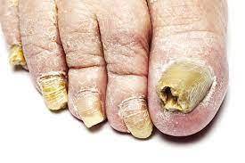 How do i prevent having toe fungus i get it every week and now something weird is happening to my t