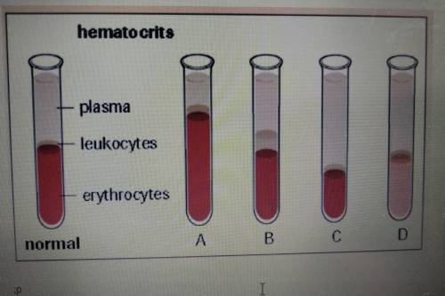 20) Cancer of the white blood cells is called leukemia. Like other cancers, leukemia is associated